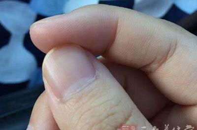 指甲上有白斑 为什么指甲上会有白斑
