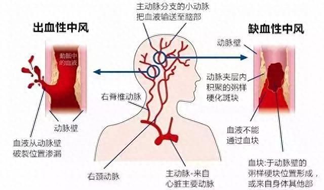 中国人的“头号杀手”不是癌症，是它